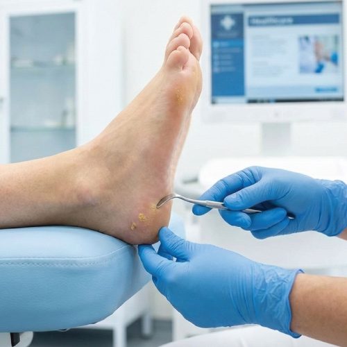 corn-and-callus-treatment